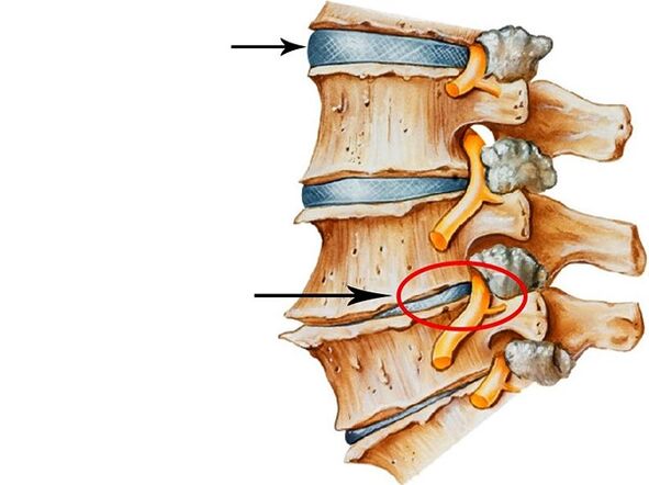 Rendellenességek az intervertebrális lemezekben