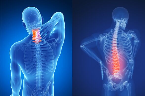 A nyaki és ágyéki gerinc osteochondrosisa