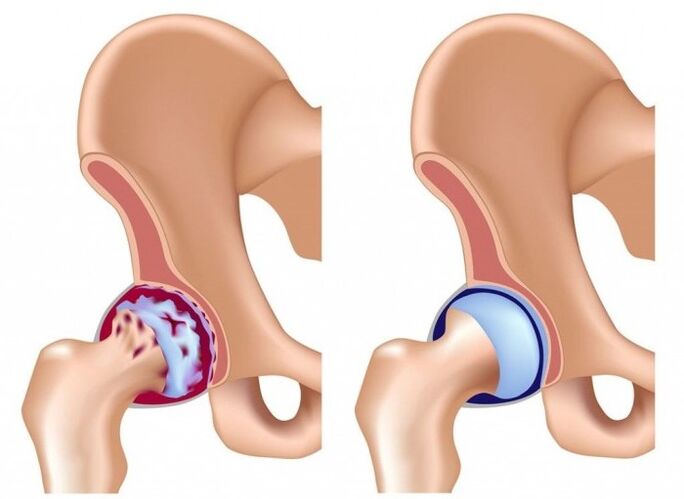A csípőízület károsodása arthrosis miatt