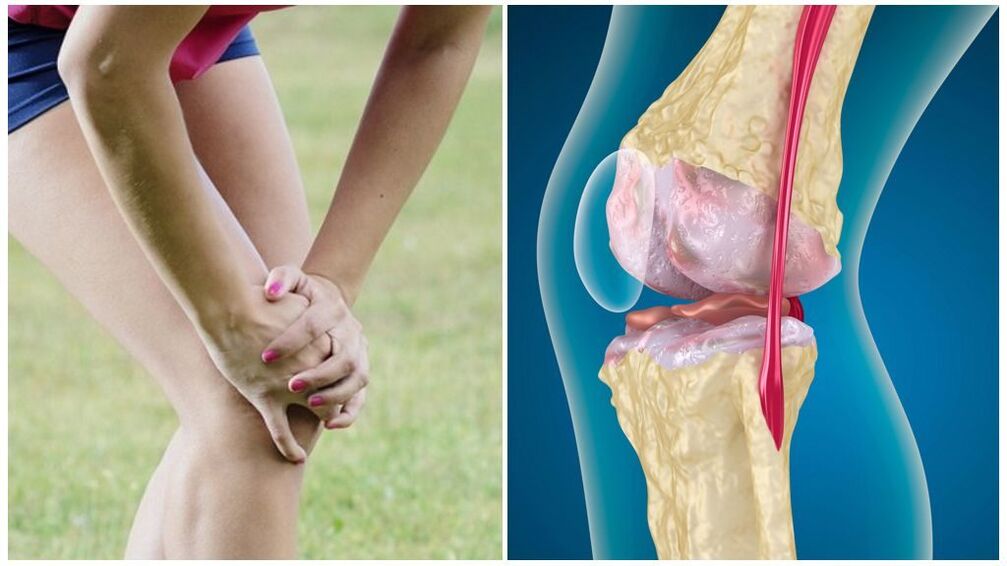 az arthrosis tünetei