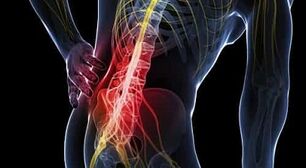 Csípőízület artrózisának kondroprotektorjai. A csípőízület kopása - Okok és tünetek